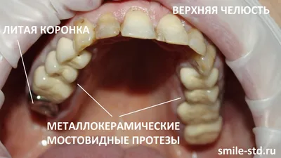 Зубная вкладка: что это такое и зачем она нужна. Статьи «ДОКТОР ДЕНТ».