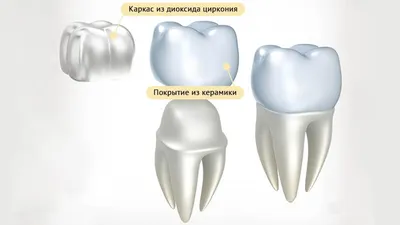 Как ставят коронку на зуб: подробные этапы процедуры установки зубной  коронки в стоматологии