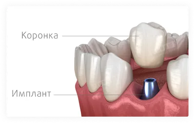 Коронка или пломба: что выбрать?