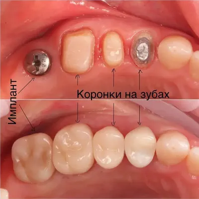 Установка коронок на зубы - цены в Нижнем Новгороде | Стоматология «Имплант  52»