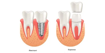 Коронка на зуб: цены под ключ на установку зубных коронок, этапы  протезирования — ROOTT