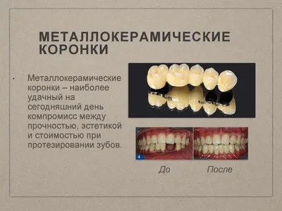 Коронка за зуб из металлокерамики | Стоматологический центр American Dental  Center