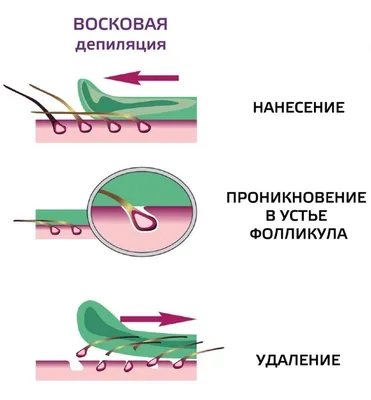 Восковая депиляция в Киеве, депиляция воском в салоне АЗБУКА КРАСОТЫ