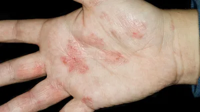 Обыкновенный псориаз и грибок на руке и пальцах человека с бляшками, сыпью и пятнами, изолированными на белом фоне. Фото аутоиммунного дерматита — Изображение аутоиммунного дерматита: 97588245