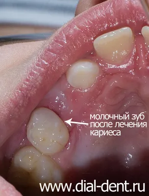 Лечение кариеса молочных зубов - Сеть стоматологических клиник  Санкт-Петербурга - Мир стоматологии