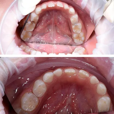 Лечение кариеса молочных зубов у детей в Томске