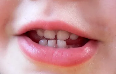 Лечение кариеса у детей в Смоленске в стоматологии Family Smile, цены и  процедуры