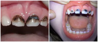 Как лечить зубы ребенку до трех лет? - Евромед Дентал