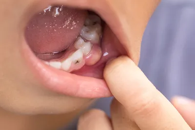 Лечение кариеса молочных зубов | Работы врача-стоматолога Грыцив Э. И. |  Наши работы