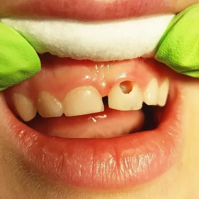 Детский кариес | Блог Кремлевской стоматологии