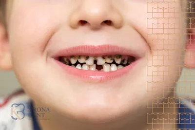Лечение кариеса зубов у детей в Челябинске недорого: лучшие цены от клиники  Dominanta74