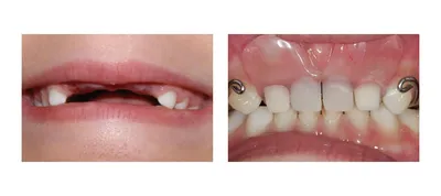 Цена на лечение пульпита молочных зубов в детских стоматологиях Вероника