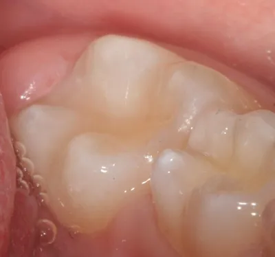 Молочные и коренные зубы у ребёнка: особенности роста и смены на постоянные  зубы у детей, когда выпадают, порядок смены