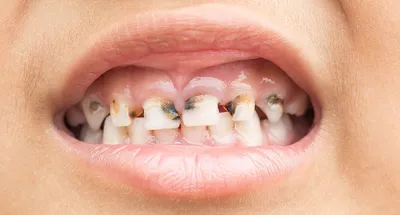 Лечение передних молочных зубов - Детская стоматология - Форум стоматологов  (стомотологический форум) - Профессиональный стоматологический портал  (сайт) «Клуб стоматологов»