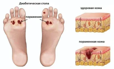 Диабетическая стопа: симптомы, причины, диагностика и лечение в лучших  клиниках - MedTour