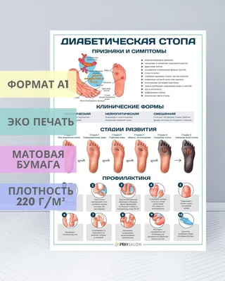 Плакат Диабетическая стопа для кабинета педикюра и подолога - купить с  доставкой по выгодным ценам в интернет-магазине OZON (306047471)