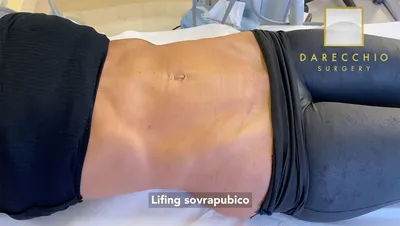 Diastasis recti | Darecchio Surgery