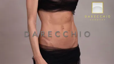 Diastasis recti | Darecchio Surgery