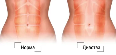 Диастаз прямых мышц живота: диагностика, симптомы, лечение - Пластика и  салонные процедуры по уходу