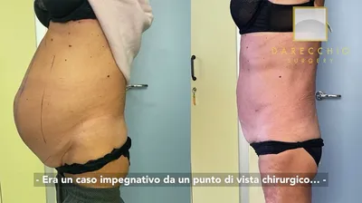 Вмешательства до и после | Darecchio Surgery