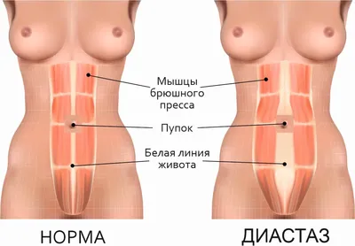 Диастаз после родов: что такое диастаз мышц живота у женщин после родов,  фото, упражнения, как убрать в домашних условиях