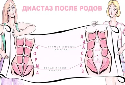 Диастаз прямых мышц живота: причины и лечение