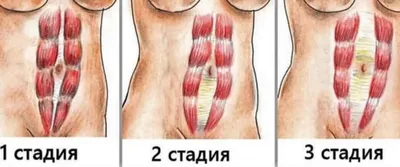 Качать пресс после родов | Как это делать правильно? | ВКонтакте