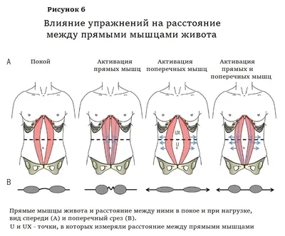 Лучшие упражнения при диастазе