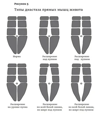 ДИАСТАЗ (расхождение) прямых мышц живота. Причины, осложнения, лечение  |Хирург Шевцов А.Н. - YouTube