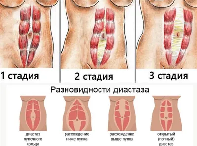 Диастаз прямых мышц живота — Википедия