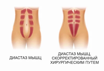 Диастаз прямых мышц живота | Александр Маркушин пластический хирург