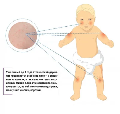Атопический дерматит у детей и советы педиатра аллерголога и диетолога  детской клиники Daily Medical
