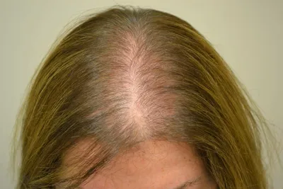 Диффузная алопеция – лечение диффузного выпадения волос в Москве, цены –  An-Tech Labs