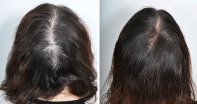 Лечение диффузного выпадения волос - Центр европейской дерматологии