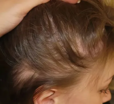 DSD de Luxe - Диффузное телогеновое выпадение волос - самая частая причина  потери волос. Это не конкретный диагноз, а сборное понятие, так как имеет  различные причины. ⠀ О факторах данного вида алопеции