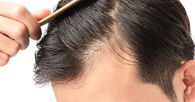 Результати лечения волос До и После | Medic Hair
