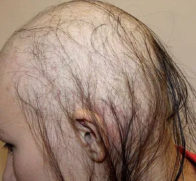 Выпадение волос: причины и лечение у женщин в домашних условиях. | Curly  assistant. | Дзен