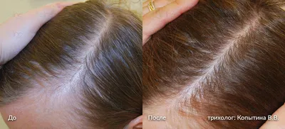 Поредение волос - Cosmedica Clinic - Dr. Levent Acar