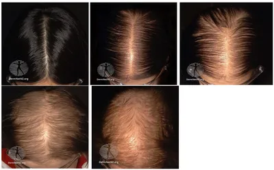 Диффузное выпадение волос у женщин | AllInfo | Дзен