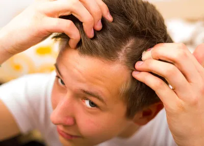 Андрогенное выпадение волос: лечение у женщин и мужчин
