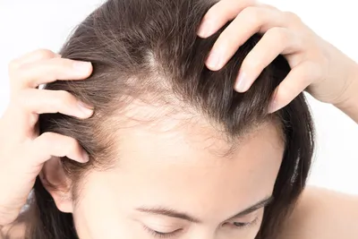 Сыворотка для быстрого роста волос, эффективное лечение против облысения,  генерического выпадения волос после родов, шелевая алопеция, пушистая линия  волос | AliExpress