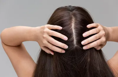 Диффузное выпадение волос: лечение диффузного выпадения волос у женщин