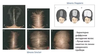 Алопеции - все виды это заболевания волос | Трихолог - Винница