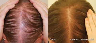 ᐉ Диффузное выпадение волос ✔️ Диффузная алопеция | Косметологическая  клиника EDIT | Косметологическая клиника EDIT
