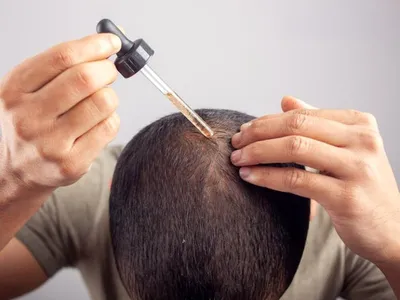 Выпадение и истончение волос, или алопеция: когда необходимо лечение у  трихолога?📌 - статьи экспертов Селенцин