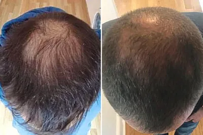 Лечение выпадения волос (алопеции) у мужчин | Клиника Современной Трихологии