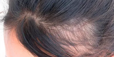Диффузное выпадение волос: причины и способы лечения