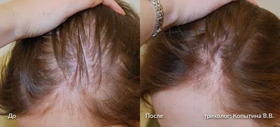 Редкие волосы: можно маскировать или надо лечить?📌 - статьи экспертов  Селенцин