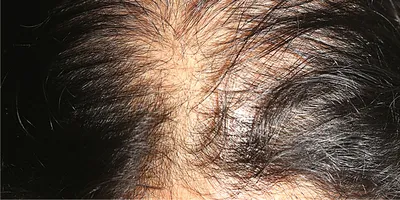 Уход за волосами в домашних условиях (маски, пилинги и т.д.) - «Диффузное  выпадение, отзыв о наболевшем. 25 лет длинных волос и катастрофа всего за  год. Как не стать параноиком над расческой » | отзывы