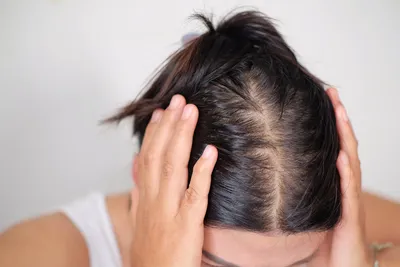 Нехватка каких элементов провоцирует выпадение волос?